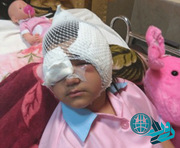 حمله سگ ولگرد به دختر ۶ ساله در رفسنجان و زخمی شدن او از ناحیه صورت