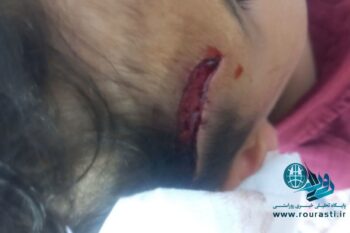 دومین حادثه از ناحیه سگ های ولگرد طی هفته جاری در رفسنجان/ این بار مصدوم شدن کودک ۷ ساله